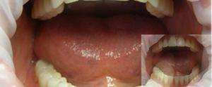 Removable dentures Acre-free and other prosthetic techniques